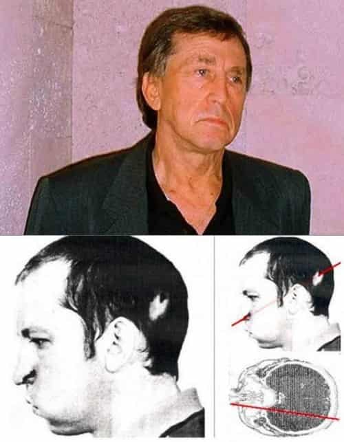 Anatoli Bugorski, proton beam accident, particle physicist, U-70 Synchrotron, Soviet Union particle accelerator, radiation exposure, high-energy physics, radiation accident survivor, stopping power radiation, unique radiation survival story, proton beam injury, Chernobyl and radiation accidents, Soviet science experiments, nuclear radiation exposure, scientific history, extreme survival stories.